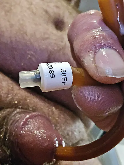 Finally got 30fr 30cc catheter in