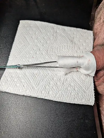 Pennington forceps holding pressure