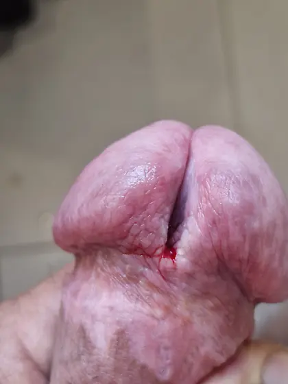 the slit of my glans is getting bigger
