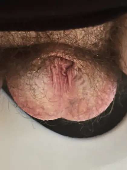 Dickless Bottom - post Penectomy