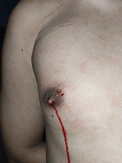 Bloody nipple 2