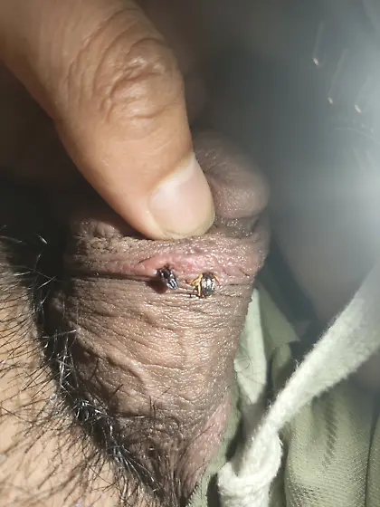 tick on dick penis bite