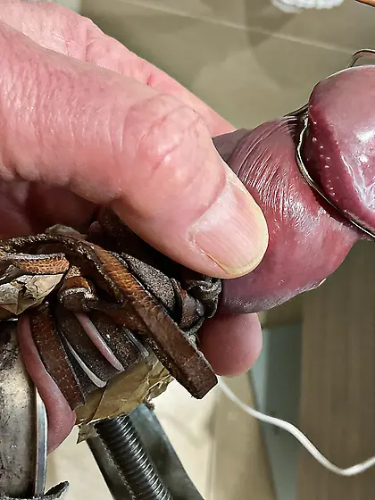 Estim ripping off papules from glans corona