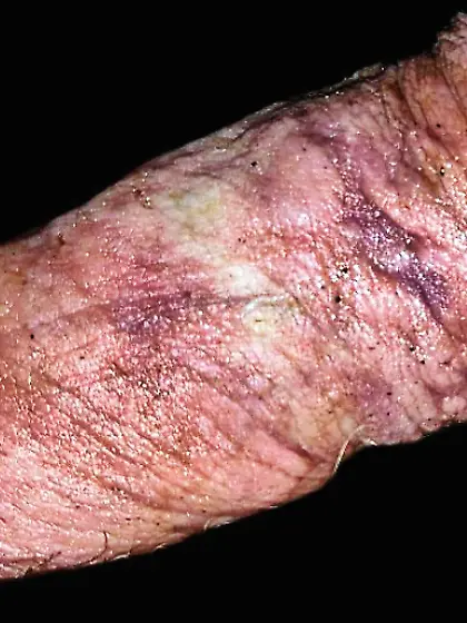 Zekes penis,  before and after.